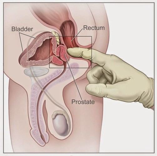 प्रोस्टेटको समस्या बढ्यो