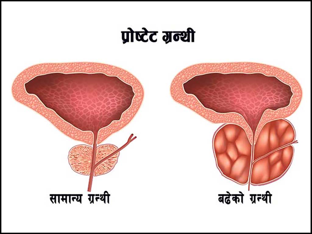 समय-समयमा प्रोष्टेट परीक्षण गर्न विज्ञको सुझाव